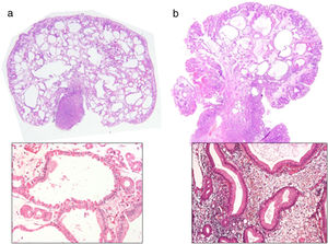 Microscopic features of pedunculated gastric polyps. Cystic dilatation of glands and foveolar expansion is observed in both polyps, but inflammation is abundant in the hyperplastic polyp (a). Parietal and chief cells lining the dilated gland is a hallmark of fundic gland polyps (b). Hematoxylin and eosin stain, x20 and x400.