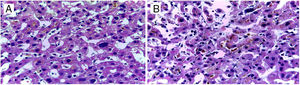 Liver biopsy. A) Sinusoidal dilation with intracytoplasmic bile pigment. B) Lakes of bile pigment in the dilated canaliculi.
