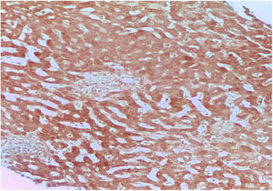Liver biopsy: negative Orcein stain.