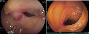 Ulcer and stricture due to Crohn