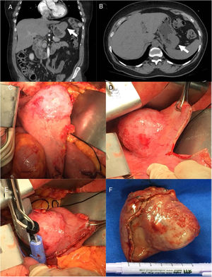 Abdominal computed tomography scan with coronal (A) and sagittal (B) views, showing focal thickening of the gastric fundus and an exophytic (4.4 × 5.2 cm) lesion with well-defined borders (white arrows). Neoplastic lesion of the anterior gastric fundus (C). Surgical images displaying wedge resection performed with a combination of linear (D) and curved (E) staplers. Surgical specimen after successful resection, measuring 7 × 5 cm (F).