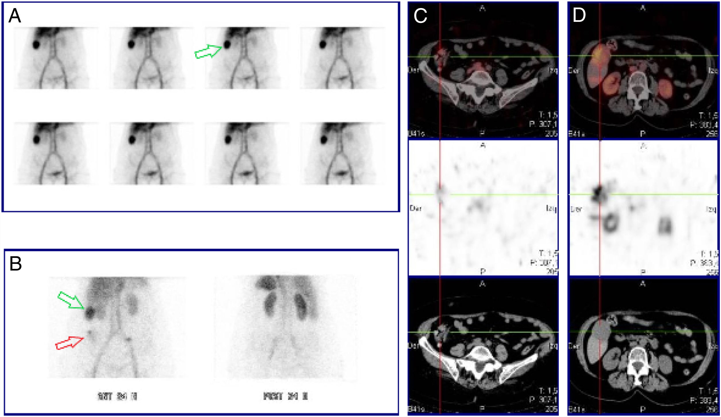 Simultaneous detection of lower gastrointestinal bleeding and hepatic ...