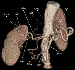 Multidetector computed tomography with volume rendering technique reconstruction that shows the vascular anatomic variant of common celiacomesenteric trunk. CMT: common celiacomesenteric trunk; CHA: common hepatic artery; CTS: celiac trunk segment; GDA: gastroduodenal artery; LGA: left gastric artery; LHA: left hepatic artery; PHA: proper hepatic artery; RHA: right hepatic artery; SA: splenic artery; SMA: superior mesenteric artery.