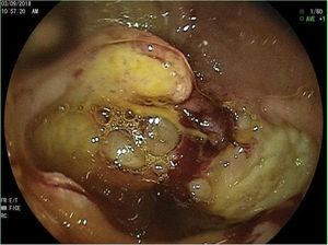 An almost completely ulcerated stricture in the third part of the duodenum.