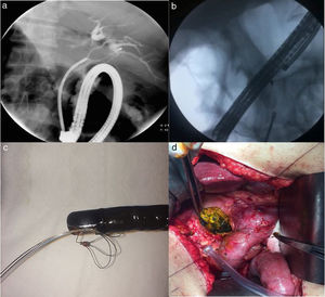 A) A cholangiography image showing a stone captured with the biliary stone extraction basket in a patient with situs inversus totalis (case 1). B) A cholangiography image showing the rescue-retrieval forceps used for removing the biliary stone extraction basket (case 2). C) Photograph of the biliary stone extraction basket after removal from the patient (case 2). D) Photograph of the surgery being performed on a patient with an impacted biliary stone extraction basket.