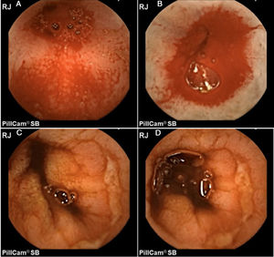 A 52-year-old man with chronic diclofenac use. A-B) Capsule endoscopy image in which active bleeding in the jejunum is initially viewed. C-D) The presence of circumferential fibrin-covered ulcers is then viewed. Original images: Dr. Jose María Remes Troche.