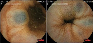 Hemangiomas observed through capsule endoscopy.