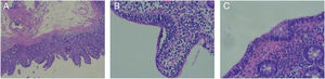 A) duodenal slice showing villous atrophy consistent with Marsh classification grade 3a (magnification ×5), B) duodenal slice showing intraepithelial lymphocytosis (magnification ×20), and C) colonic slice showing intraepithelial lymphocytosis (magnification ×30).