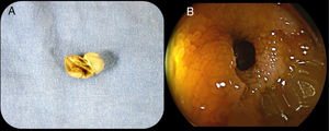 A) The deformed patency capsule after its passage through the stricture and its expulsion. B) The intestinal stricture observed at enteroscopy.