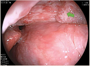 Granulomatous lesion in the right glossoepiglottic fold (green arrow).