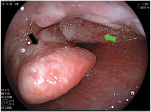 Granulomatous lesion in the right glossoepiglottic fold (green arrow), extending to the epiglottis (black arrow).