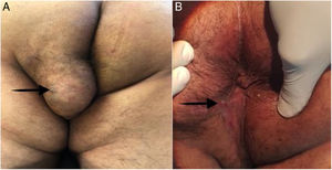 (A) A well-defined, 6×6cm tumor in the left buttock and perineum. The black arrow points to the external orifice of the perianal fistula. (B) The perianal wound was healed by secondary intention, at the follow-up at 12 months. The black arrow points to the scar of the completely healed perianal fistula