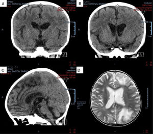 A) Coronal view of non-contrast-enhanced tomography scan. Hypodense zones are in the superior sagittal sinus (hypodense triangle sign). B) Coronal view of non-contrast-enhanced tomography scan. In a posterior slice, hyperdense zones alternate, supporting the diagnosis of cerebral venous sinus thrombosis in the superior sagittal sinus. C) Sagittal view of non-contrast-enhanced tomography scan. Hyperdense zones at the level of the superior sagittal sinus (venous sinus thrombosis). D) Magnetic resonance image of the encephalon, axial view in phase T2. Zones of venous infarct in the frontal and left parietal-occipital regions.