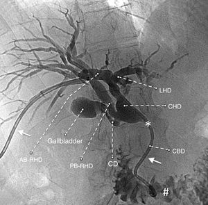 Cholangiography with dilated bile ducts and an anatomic variant: anterior branch of the right hepatic duct (AB-RHD), posterior branch of the right hepatic duct (PB-RHD), cystic duct (CD), left hepatic duct (LHD), common hepatic duct (CHD), common bile duct (CBD).