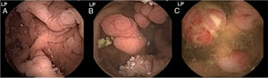 A-C) Images from the VCE study showing numerous polyps of different size and stage in the antrum, jejunum, and colon, respectively.