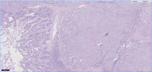 Image of the jejunal sample magnified 5 times. Normal intestinal epithelium can be seen to the left, and submucosa with infiltration of atypical pigmented cells to the center right. Stain: hematoxylin and eosin.