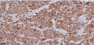 Image of the jejunal sample magnified 20 times. Melanocytes diffusely infiltrating the tissue (brown color). Stain: MelanA.