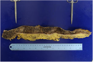 Dissected macroscopic colon. Both strictures are indicated by the metal forceps, in the transverse colon and descending colon, respectively.