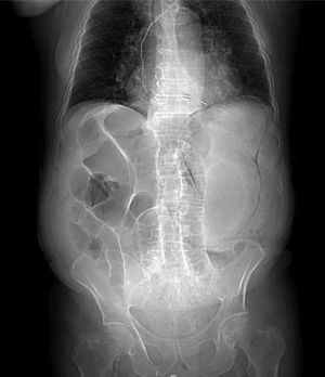 Luminogram from an abdominal CT scan with iv contrast medium. Intraparietal gas forming a dilated gastric silhouette is shown, as well as the bowel segment dilation.
