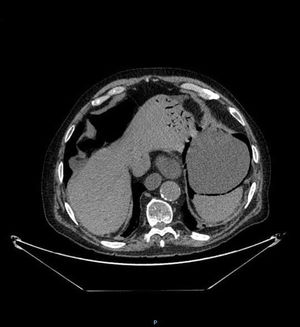 Axial view of the abdominal CT scan with iv contrast medium showing abundant quantities of intraparietal gas in the stomach, small bowel segment dilation with a maximum caliber of 4.3 cm, and a pneumoperitoneum of moderate quantity adjacent to the gastric body and anterior abdominal wall.