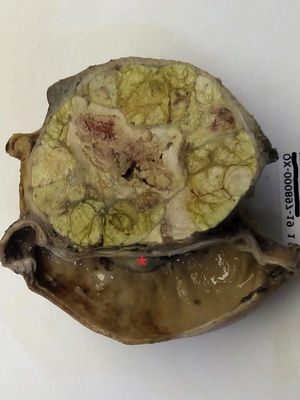 Macroscopic image of the hepatocellular carcinoma. The distal part of the stomach can be seen, with the tumor invading the wall and the mucosa of the lesser curvature of the stomach (⁕).