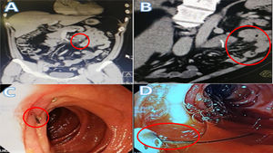 A: Radio-opaque foreign body embedded in a small bowel segment, B) Inflammatory mass in the small bowel segment located at the level of the proximal jejunum, C) Wire bristle embedded in the intestinal wall, D) Extraction of the wire bristle with a biopsy forceps.