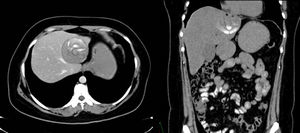 As the imaging study approach, a liver CAT scan was performed.