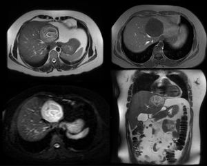 A contrast-enhanced MRI was performed.