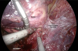 A cyst firmly attached to the inferior vena cava was found during the surgery.