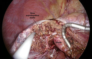 The cyst was very close to the middle hepatic vein.