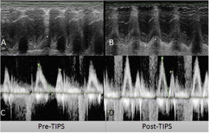 Pre-transjugular intrahepatic portosystemic shunt (TIPS) (A, C) and post-TIPS (B, D) echocardiogram measurements. A) Pre-TIPS TAPSE of 18.8mm. B) Post-TIPS TAPSE of 14.4mm. C) Pre-TIPS E/A wave ratio of 1.2. D) Post-TIPS E/A wave ratio of 1.54. TAPSE: tricuspid annular plane systolic excursion.