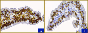 Histologic characteristics. Between 8 and 12 villi are shown, with a villus to crypt ratio of 2-3:2. A slightly enlarged mononuclear infiltrate with up to 6 eosinophils per high power field were found in the lamina propria (x40). Immunohistochemistry with CD45 (A) and CD8 (B) antibodies show more than 100 mainly cytotoxic lymphocytes (in dark brown) for every 100 enterocytes, despite the fact that the villi are the usual size (original magnification x40). There is no evidence of hyperplasia of the crypts or micro-organisms. The enterocytes, goblet cells, and Paneth cells are normal. The color of the figure can only be appreciated in the electronic version.
