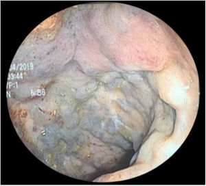Colonoscopy study showing the multiple tortuous and dilated vessels, with the characteristic coloring, in the rectum.