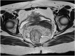 Axial view of the MRI. The arrow is pointing to the thickened rectal wall measuring 16 mm, with important reduction in the lumen and thickening of the mesorectum.