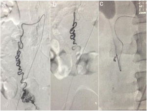 a) Angiography of the abdominal aorta, showing the emergence of the aberrant vessel in a caudal direction and at the level of the rectum, the main vascular tract at which the multiple tortuous branches that make up the hemangioma are seen. b) Polyvinyl alcohol microparticle administration. c) Complete embolization with placement of the coil.