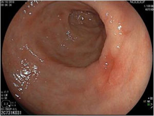 Type 0IIc depressed lesion on the posterior surface of the antrum in white light endoscopy. Histology showed adenocarcinoma in situ.