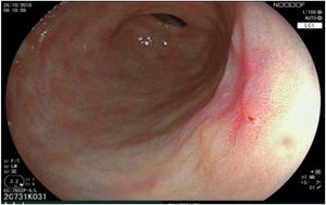 The same lesion seen through LCI (Linked Color Imaging, Fujifilm Co., Japan) virtual chromoendoscopy.