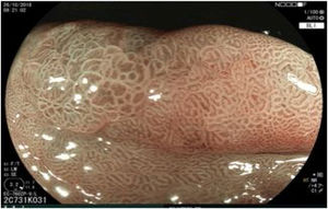 Minimum image magnification and BLI (Blue Laser Imaging, Fujifilm Co., Japan) virtual chromoendoscopy of the margin of the lesion, showing a demarcation line that delimits the neoplastic lesion and the normal mucosa.