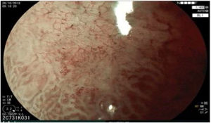 Maximum image magnification and BLI (Blue Laser Imaging, Fujifilm Co., Japan) virtual chromoendoscopy of the depressed part of the lesion, showing the irregular microsurface and dilated and tortuous microvessels.