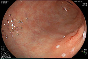 Demarcation of the resection limits (ERBE VIO 200S, Soft mode, Effect 6, 100W).