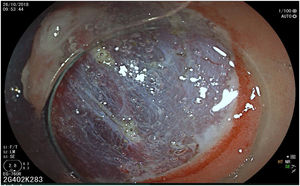 Circumferential incision of the mucosa, showing the submucosal layer (ERBE VIO 200S, Endocut I, Effect 2).