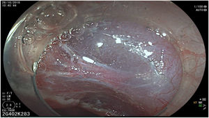 Submucosal layer dissection utilizing the cap on the tip of the endoscope (ERBE VIO 200S, Forced mode, Effect 2, 50W). Observe the perforating vessels.