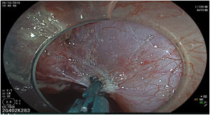 Hemostasis of the perforating vessels with the SB Knife (Sumitomo Co., Japan) (ERBE VIO 200S, Soft mode, Effect 6, 100W).