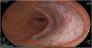 Final aspect of the en bloc resection site with sparing of the muscularis propria layer.