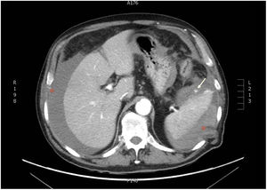 Hemoperitoneum and a large peri-splenic hematoma measuring 10 × 12 × 13 cm (*) with foci of contrast medium extravasation in the lower splenic pole (white arrow), corresponding to a grade V splenic injury.