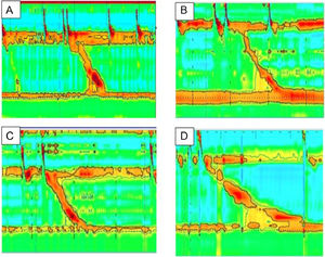 Esophageal manometry of the patients with esophagogastric junction outflow obstruction. Patients with a history of post-fundoplication dysphagia. High-resolution manometry was consistent with esopgagogastric junction outflow obstruction. Mean relaxation pressure was 24 mmHg, peristalsis was normal in all cases.