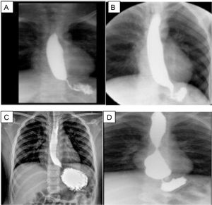 Esophagram of the patients after fundoplication. A) Case 1, overdistension of the esophageal lumen upon the passage of barium. The esophagogastric junction (EGJ) is seen under the diaphragm; B) Case 2, narrowness of the EGJ; C) Case 3, the esophagus is slightly overdistended in its three thirds, with thinning of the EGJ; D) Case 4, esophagus with conserved caliber in the first two thirds, but greatly augmented in the distal third, blunt tip, and even a rounded image, and reduced caliber of the EGJ, probably overefficiency of the fundoplication.
