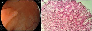 A) Endoscopic appearance of a hyperplastic polyp. It is characterized by a flat or slightly elevated lesion that is transparent or pale. B) Histologic appearance of hyperplastic polyp, showing elongated crypts, a higher number of cells than in normal mucosa, conserved structure and maturation, a normal number of goblet and absorptive cells, with regular nucleus and basal distribution. A chronic inflammatory type of lymphocytic predominance can be seen in the lamina propria.