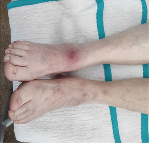 Nonulcerated, erythematous-purplish subcutaneous nodules on the lower limbs.