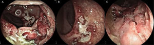 A) Rectosigmoidoscopy showing the severe inflammatory changes on the first and second Houston’s valves: marked edema, erythema, and deep, fibrin-covered ulcer. B) Severe inflammatory involvement in the distal rectum, with obvious edema and mucosal thickening. C) Deformity and deep ulcer at the level of the distal rectum, with irregular edges and a sharply demarcated aspect, with anal canal involvement.